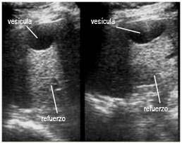 Refuerzo posterior. Imagen de la vesícula biliar en un eje transversal y en un eje longitudinal. Falso aumento de ecogenicidad en relación con zonas vecinas.