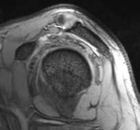 Hallazgos acromiales asociados a lesiones del manguito de los rotadores en resonancia magnética Acromial Findings Associated with Rotator cuff s Lesions in Magnetic Resonance Mercedes Ávila 1