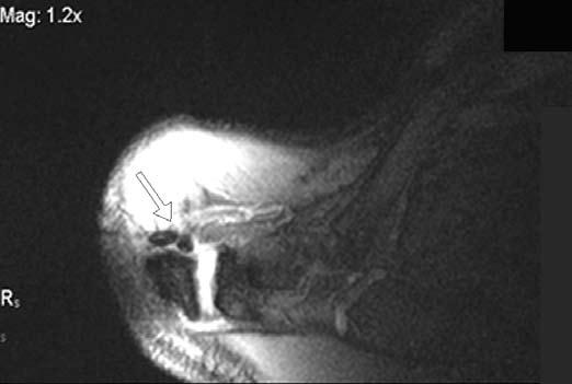 artículos de investigación Fig. 1. Imagen en corte coronal oblicuo eco turbo del espin T2 de un hombro derecho.