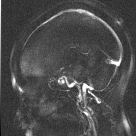 MEDISAN 2013;17(1): 143 Fig 1. Angiorresonancia (vista sagital) y angiografía carotídea derecha (vista oblicua).