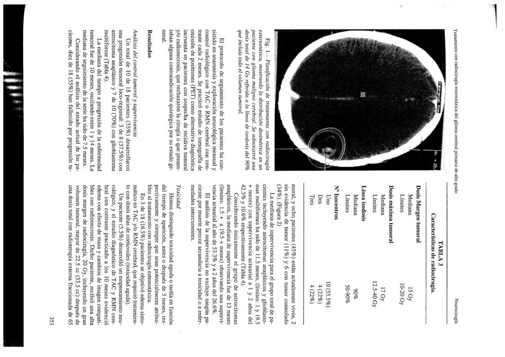 Fig. 1.- Planificación de tratamiento con radiocirugía estereotáxica, mostrando la distribución dosimétrica en un paciente con glioma maligno cerebral.