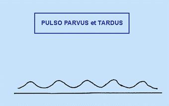 el pulso es pequeño (Parvus) y el ascenso es lento (tardus). AMPLITUD DISMINUÍDA.