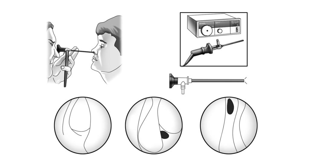 194 Otorrinolaringología y patología cervicofacial Rinoscopia anterior con fibra óptica (endoscopia nasal). Esta exploración proporciona una información muy completa del interior de las fosas nasales.