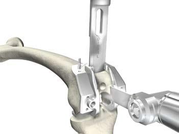 Sistema de rodilla Triathlon Protocolo quirúrgico Instrumental Express Figura 4 2. Escoplo y sierra: Monte el escoplo para escotadura e insértelo en la ranura.