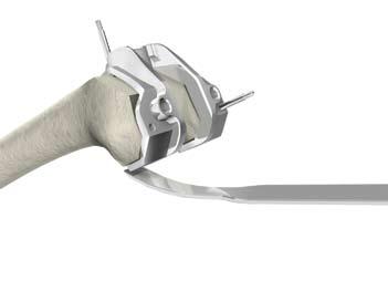 Corte los bordes medial y lateral de la escotadura con una sierra oscilante para completar la osteotomía.