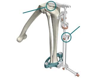 Sistema de rodilla Triathlon Protocolo quirúrgico Instrumental Express u Acople el Impactador Extractor femoral al martillo deslizante y extraiga el componente femoral de prueba PS o CR del fémur.
