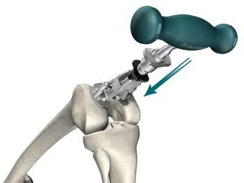 Figura Figura 2 Preparación femoral Alineación femoral intramedular u El Adaptador Universal permite el acoplamiento de brocas y tornillos.