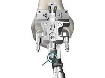 Sistema de rodilla Triathlon Protocolo quirúrgico Instrumental Express Botón u El bloque de ajuste permite un nivel de resección de 8 mm (el grosor distal del componente femoral) y 0 mm (utilizado