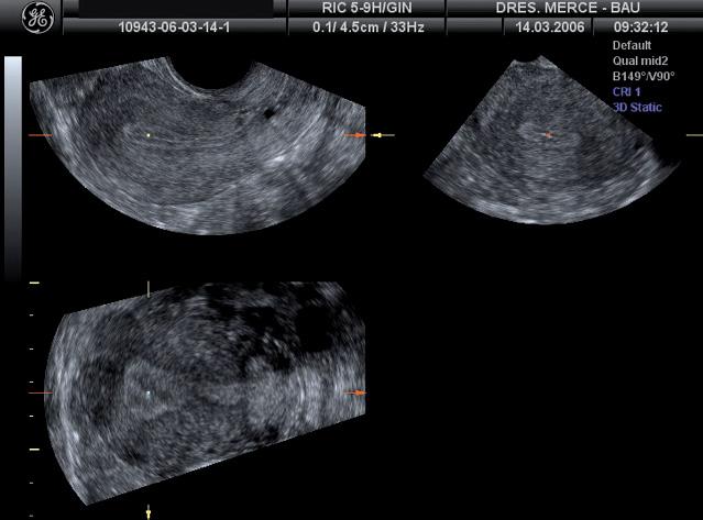 259 Figura 1. Representación multiplanar de un útero normal. La adquisición se realiza desde el plano longitudinal del útero (imagen superior izquierda). Figura 2.
