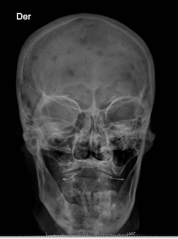 Figura 1: Radiografía de cráneo con