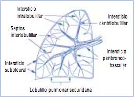 Patrón Intersticial - Intersticial axial o peribroncovascular -
