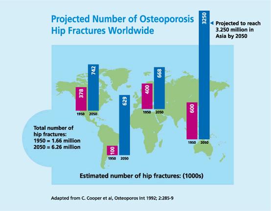 Por qué un taller de osteoporosis? España: 350.