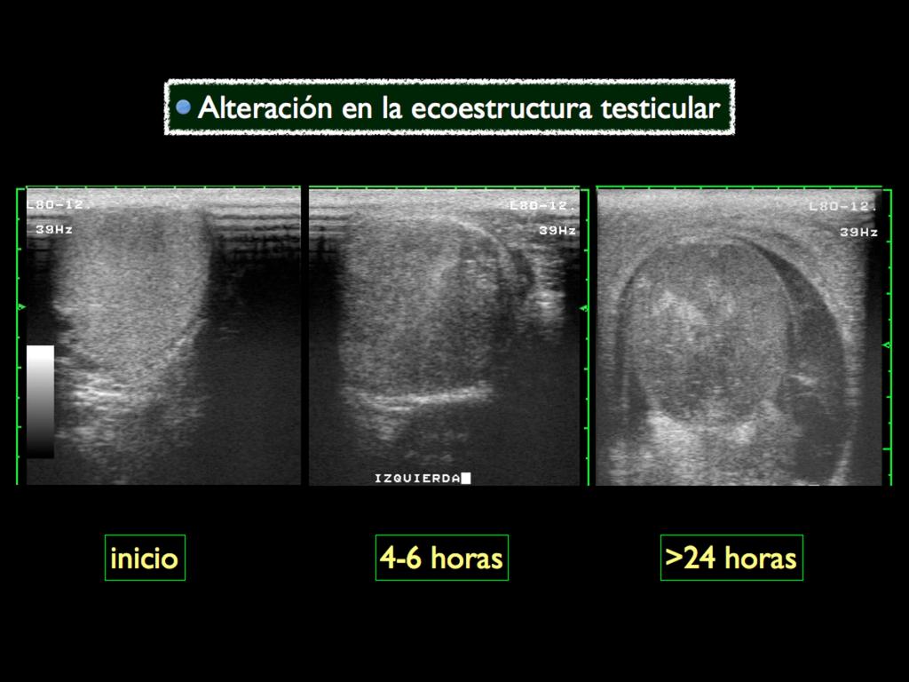 Fig. 4: Alteraciones en la ecoestructura testicular en función del tiempo transcurrido desde la instauración del cuadro Torsión testicular incompleta o subtorsión: flujo