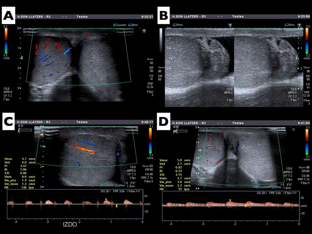 Fig. 5: Torsión testicular incompleta izquierda: A. flujo vascular en el teste izquierdo disminuido; B.masa ecogénica extratesticular (cordón torsionado); C y D.
