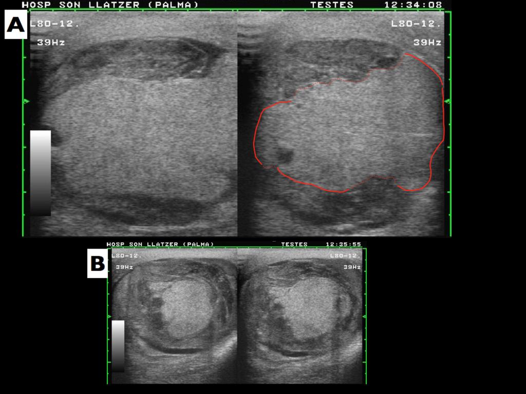 Fig. 6: Rotura testicular: A. en línea contínua los segmentos íntegros de la capa albugínea y en línea discontinua los segmentos de interrupción de la albugínea; B. hematocele alrededor del teste.