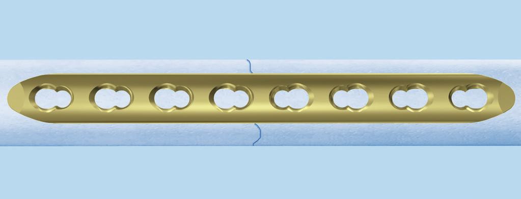 Técnica para placas estándar 3 Colocación de la placa Coloque y fije preliminarmente la placa sobre el hueso.