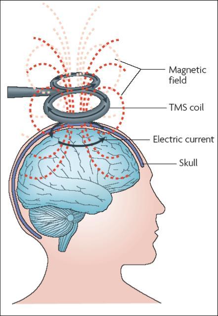 Terapia: Estimulación magnética transcraneal ETMr técnica no invasiva.