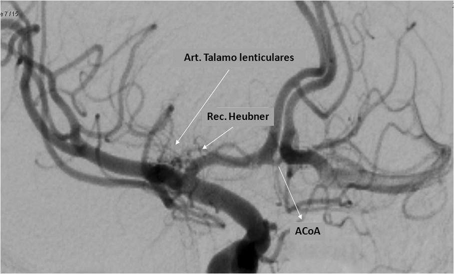 10 La arteria calcarina se dirige por el surco calcarino y alcanza la corteza visual en el lóbulo occipital.