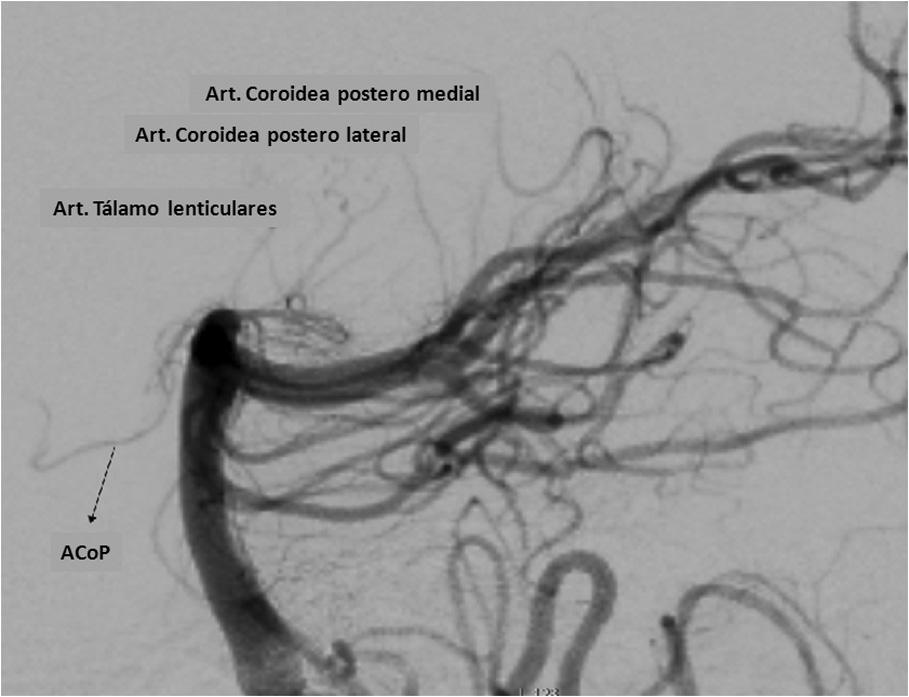 Anatomía y fisiopatología de la enfermedad cerebrovascular a través de imágenes 11 circulación colateral. Difícilmente se observan en angiografías comunes.