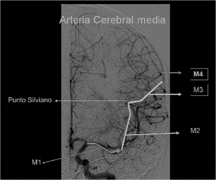Anatomía y fisiopatología de la enfermedad cerebrovascular a través de imágenes 5 Fig. 6. Arteria cerebral media y diferentes segmentos. Véase explicación en el texto.