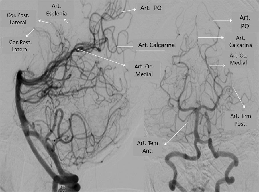 Anatomía y fisiopatología de la enfermedad cerebrovascular a través de imágenes 9 Segmento P2 o segmento ambiens (Figura 13, P2): va de la unión de la arteria cerebral posterior y la comunicante