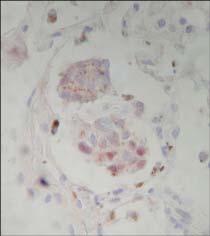 B: NM primaria, tipo celular mixto, melanización grado 3, marcación homogénea, fuerte, patrón citoplasmático y nuclear difuso (obj. 40x). C: metástasis pulmonar de B (obj. 100x).