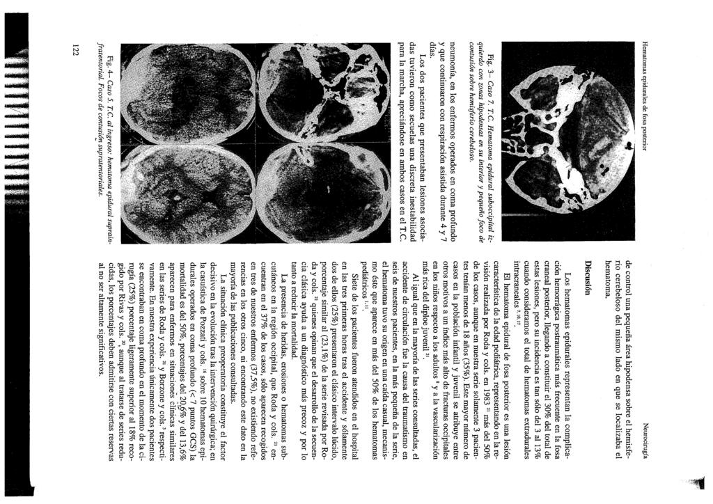 de control una pequeña área hipodensa sobre el hemisferio cerebeloso del mismo lado en que se localizaba el hematoma. Discusión Fig. 3- Caso 7. T.e. Hematoma epidural suboccipítal izquierdo con zonas hipodensas en su interior y pequeño foco de contusión sobre hemisferio cerebeloso.