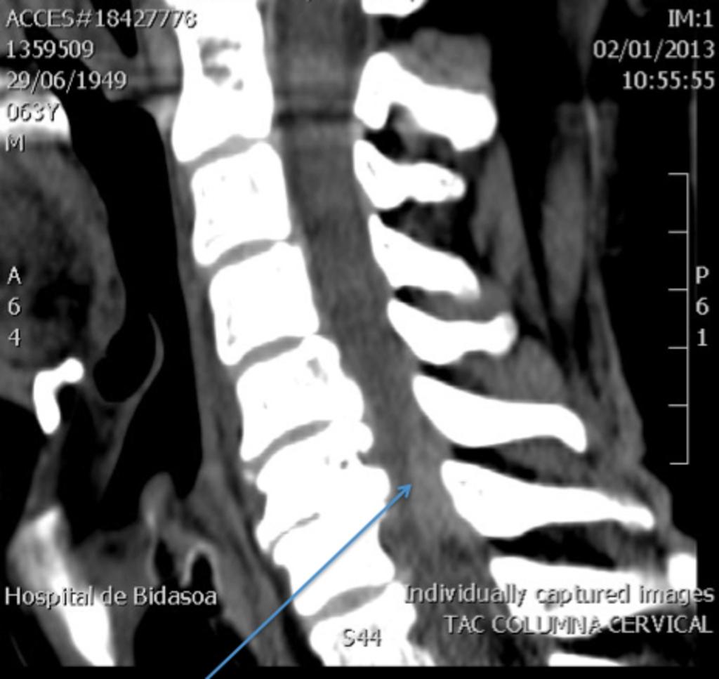 Fig. 9: Hematoma epidural. TC columna cervical sin contraste, reconstrucción sagital.