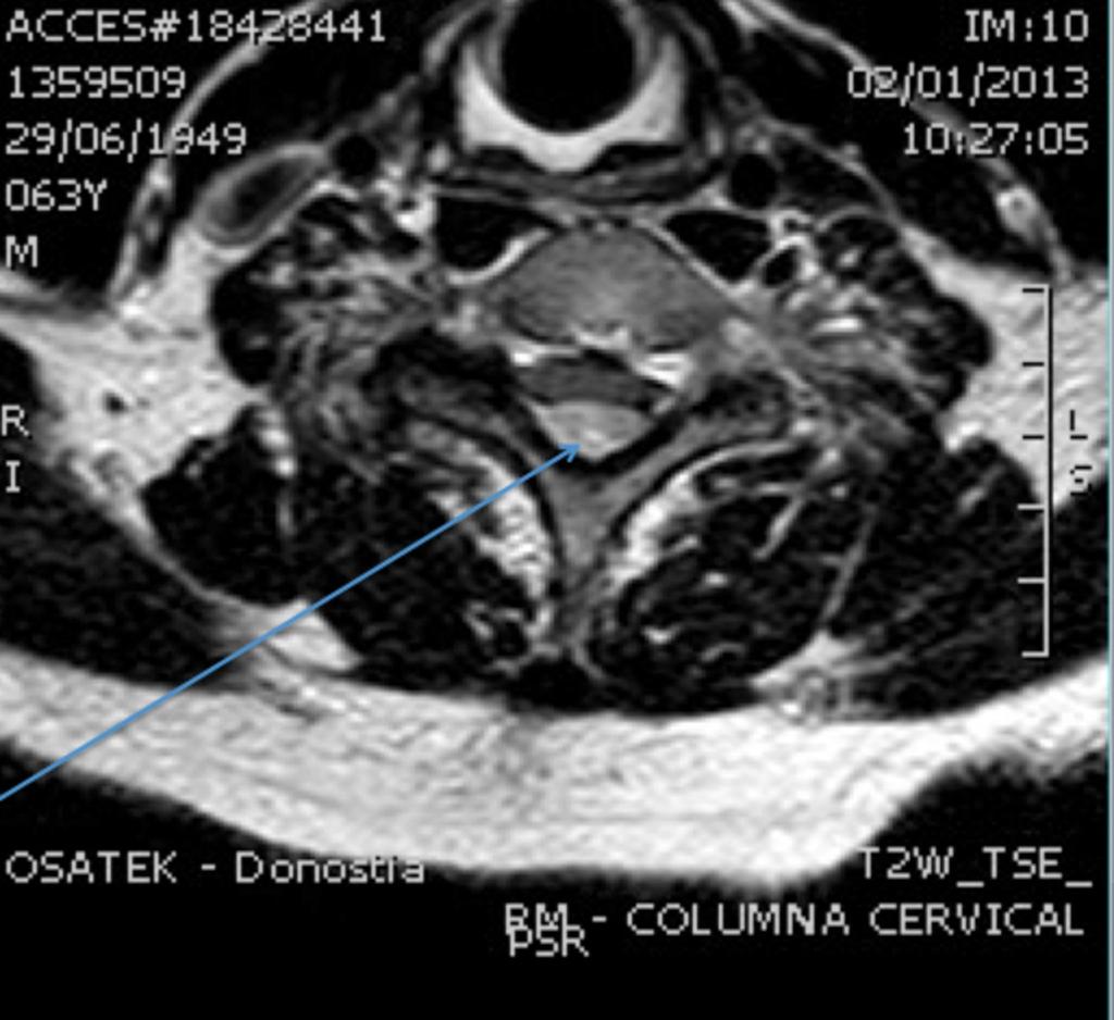 Fig. 14: Hematoma epidural. RM. T2/TSE/axial.