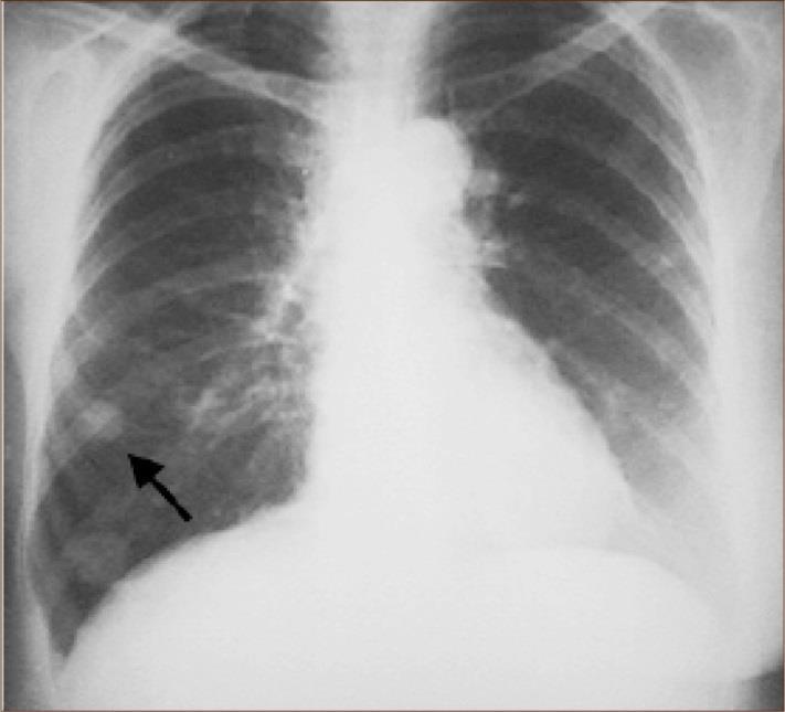 NÓDULO PULMONAR Opacidad única, circunscrita y esférica, de diámetro máximo 30 mm, rodeada de pulmón sano y no asociada a atelectasia,
