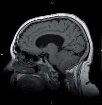 Hidrocefalias en el adulto alteración del desarrollo del cerebelo. El tratamiento consiste en una derivación ventriculoperitoneal, y sólo excepcionalmente cistoperitoneal.