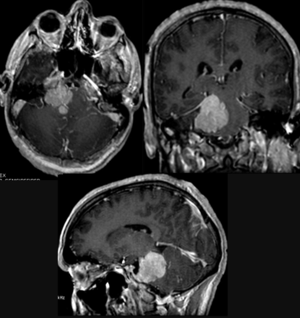 Fig. 4: Paciente de 34 años con hemangiopericitoma del APC (mismo caso anterior).