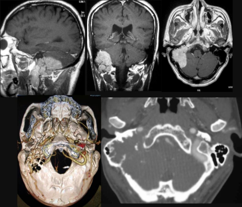 Fig. 10: Paciente con tumor fibroso solitario. Masa sólida derecha de base de cráneo muy vascularizada.