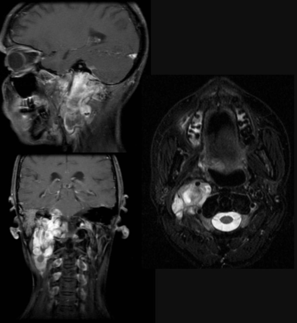 Fig. 12: Paciente con rabdomiosarcoma de base de cráneo en tratamiento con quimioterapia.