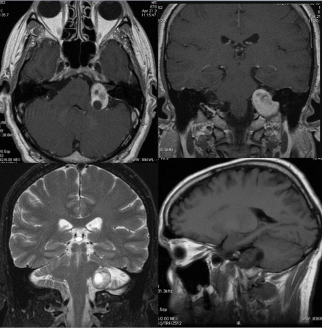 Fig. 16: Paciente de 51 años con neurinoma del XI par craneal.
