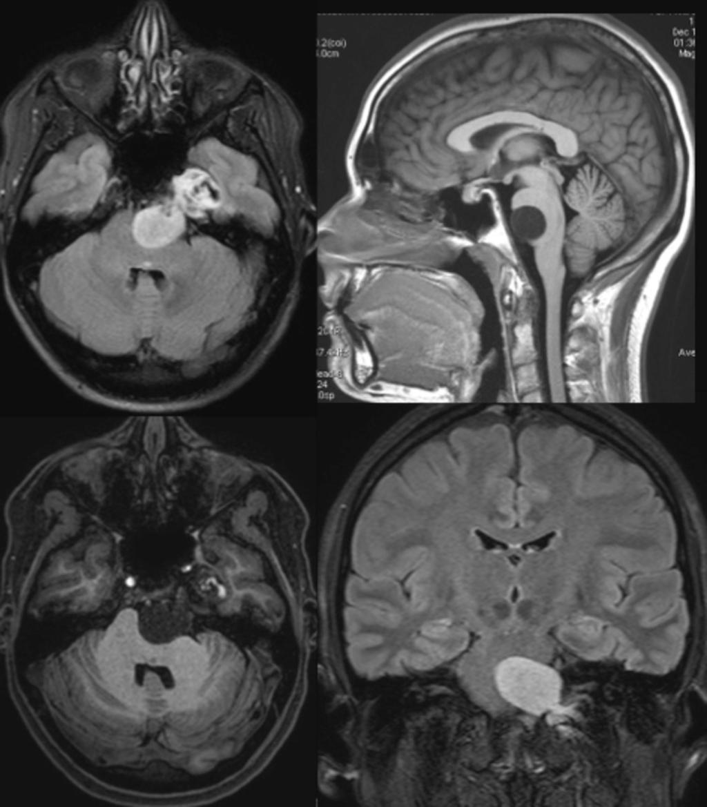 Fig. 19: Paciente de sexo femenino de 27 años con tumoración condroide de bajo grado en base de cráneo en región petroclival izquierda e historia de síndrome de Ollier conocido (encondromatosis