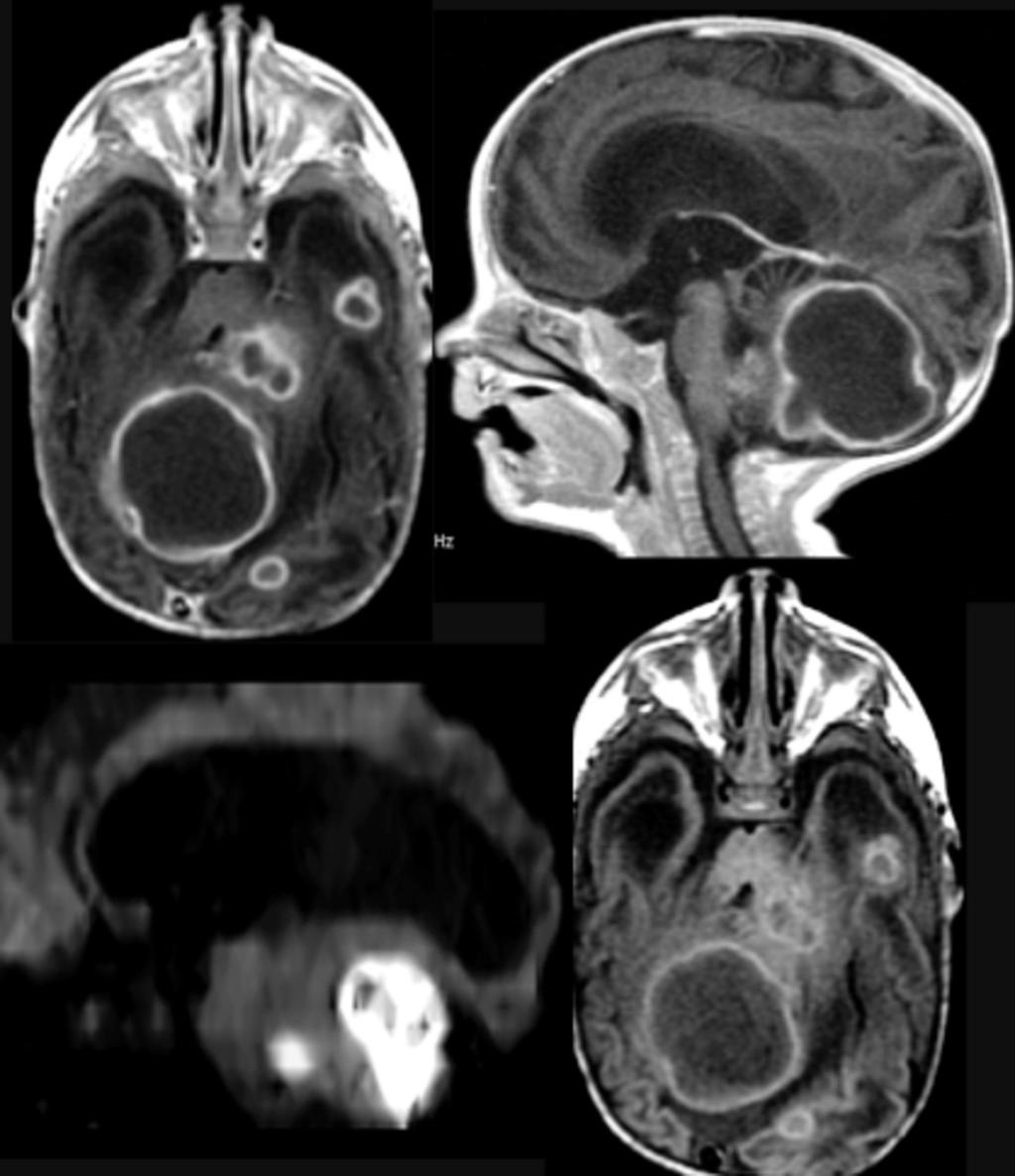 Fig. 22: Abscesos cerebelosos en paciente de 9 semanas de vida. Imagenes de RM potenciadas en T1+ C que muestra múltiples lesiones con refuerzo anular en LTI y LO, con hidrocefalia asociada.