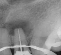 a los tres, seis meses o más para comprobar que los tejidos de soporte del diente estén sanos.