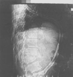 Figura 6. Fractura compresiva del margen antero-superior del cuerpo vertebral de L1, con invasión al conducto raquídeo y cifosis. 2. El 57% de los casos tenía menos de 20º de cifos.