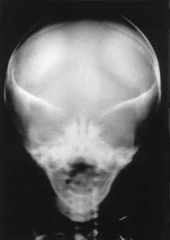 Figura 4. Radiografía de manos tipos 3 donde se observan las fusiones óseas complejas. Figura 3. Radiografía del cráneo donde se observa la craneosinostosis.