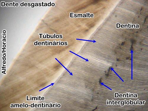 ntinal externo o ntina l manto). Dado que los calcosferitos no presentan matriz inorgánica, al smineralizar el diente se observan como círculos eosinófilos periféricos.