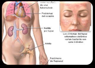 CONCEPTOS GENERALES Lupus Eritematoso Sistémico (LES): Enfermedad inflamatoria crónica de naturaleza autoinmune y de etiología desconocida, caracterizada por afectación de múltiples órganos y