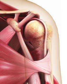 Anatomía del hombro accidente o por el uso excesivo. Hay enfermedades que también pueden afectar el hombro.