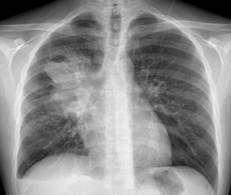 Linfoma Hodgkin Afectación pulmonar en 10% en el momento del diágnóstico. Más en recurrencias.