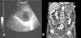 Rev Méd Chile 2008; 136: 38-43 mos, vómitos en 3, dolor abdominal difuso en 2 y derrame pleural clínico en 2.