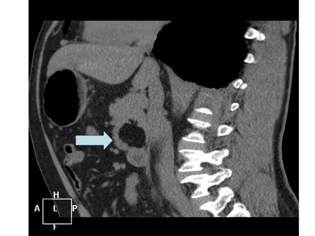 Fig. 2: TAC de abdomen corte sagital, en el que se