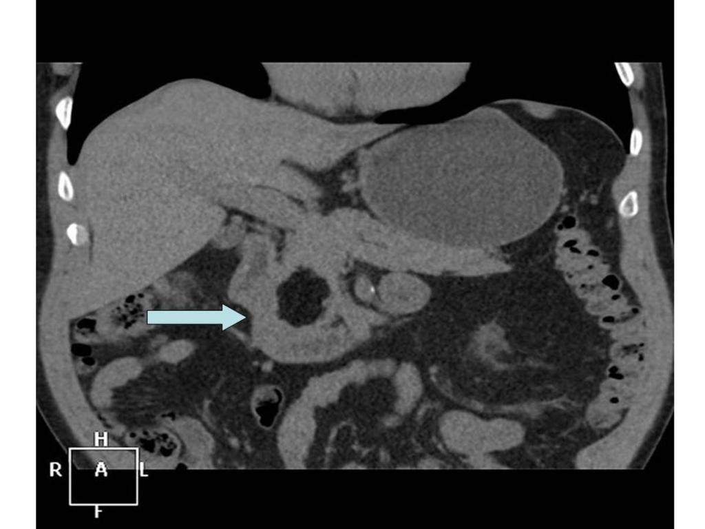 Fig. 4: TAC de abdomen en un corte coronal, donde se observa una lesión hipodensa circunscrita a la cabeza del páncreas, compatible con lipoma pancreatico Fig.
