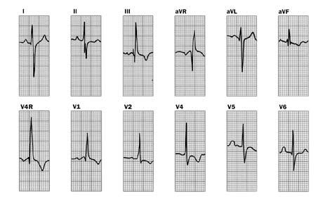 Crecimiento biauricular Etiología: las cardiopatías que comprometen el corazón izquierdo en fases avanzadas originan fallas del ventrículo derecho, dilatación del anillo tricuspídeo e insuficiencia