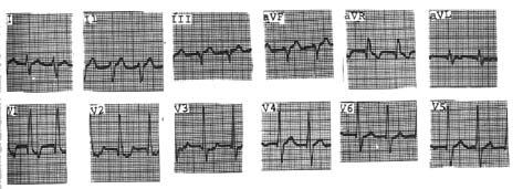rama derecha con gran dextrorrotación no es rara la aparición de ondas Q en derivaciones precordiales derechas o, incluso, en derivaciones de cara inferior que pueden simular infarto del miocardio.