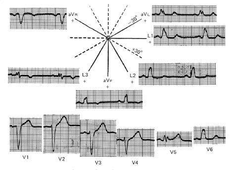 99 WPW R ancha y alta de V1 a V2 con T positiva que simula infarto dorsal. Figura tomada del libro Cardiología 1999, pág. 146.